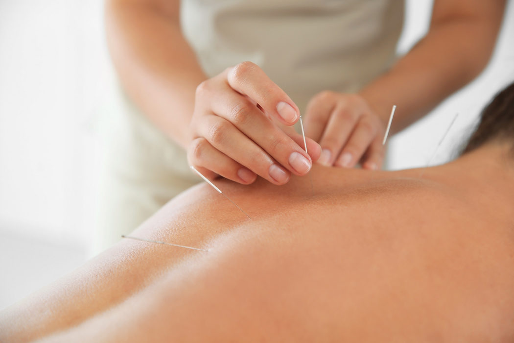 Séance d'acupuncture pour les douleurs de règles et l'endométriose