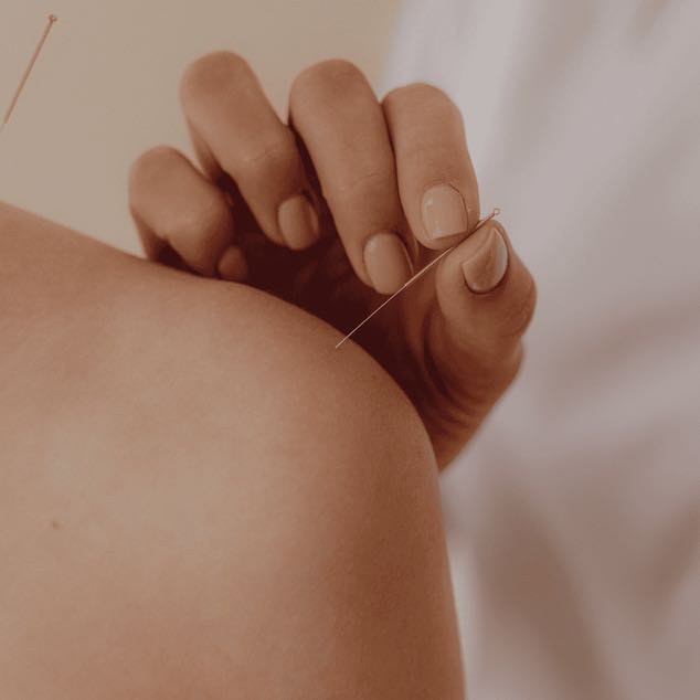 Pose d'aiguilles d'acupuncture lors d'une séance à Genève