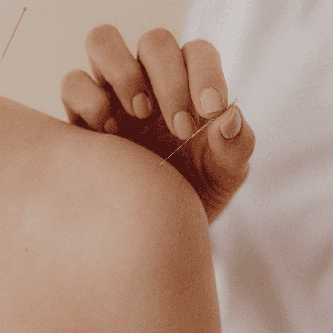 Séance d'acupuncture